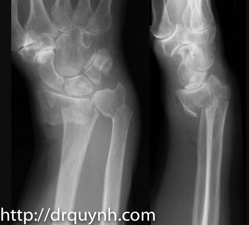Gãy ngón tay 1 tháng chưa can xương phải làm sao  Bệnh viện Nhân Dân 115