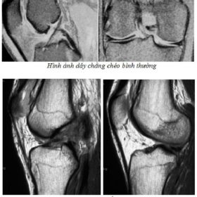 Thông tin chi tiết về Mri đứt đây chằng chéo trước