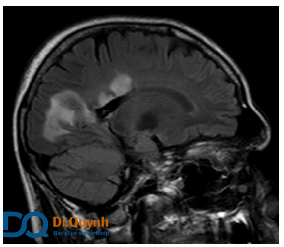 Dấu hiệu sán chó lên não trên phim chụp MRI