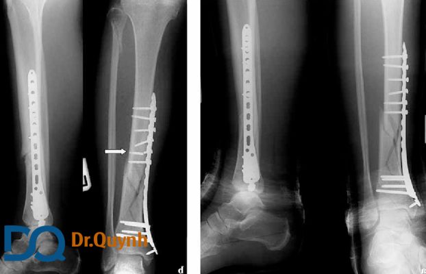 Phẫu thuật tháo nẹp vít xương cẳng chân