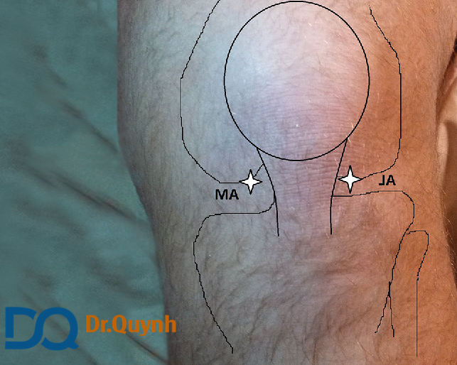 Vị trí tiêm khớp gối phía trước