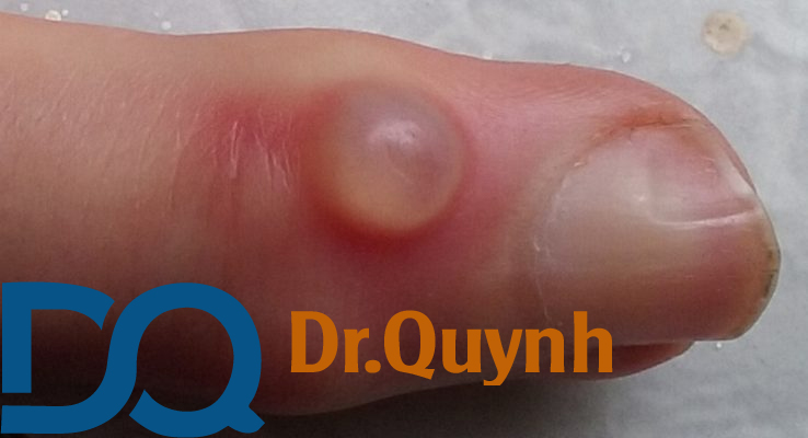 U bã đậu ở ngón tay được biết đến là một dạng u lành tính xuất hiện ở những ngón tay. U bã đậu xuất hiện với hình dạng tròn, bầu được bao bọc bởi lớp vỏ. Bên trong là chất bã mềm, màu vàng nhạt hoặc vàng đục