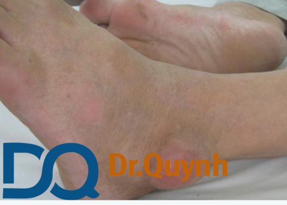 Sưng mắt cá chân gây ra cảm giác khó chịu ở khớp cổ chân. Bệnh nhân sẽ có cảm giác đau nhói vì bị chấn thương mạnh ở chân như viêm khớp lâu ngày không chữa trị. Cổ chân bị bong gân là nguyên nhân dẫn đến sưng mắt cá.