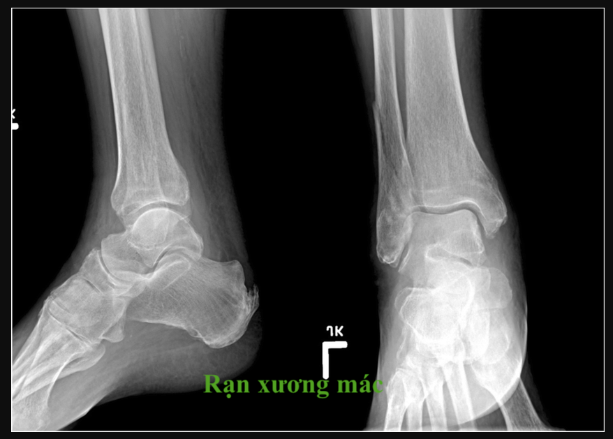 hình ảnh rạn xương mác