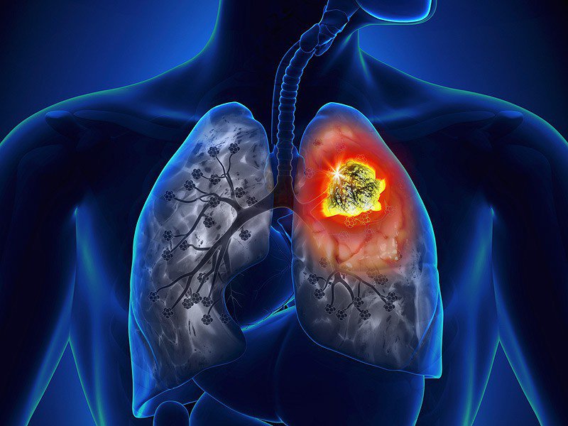 xét nghiệm tầm soát ung thư phổi