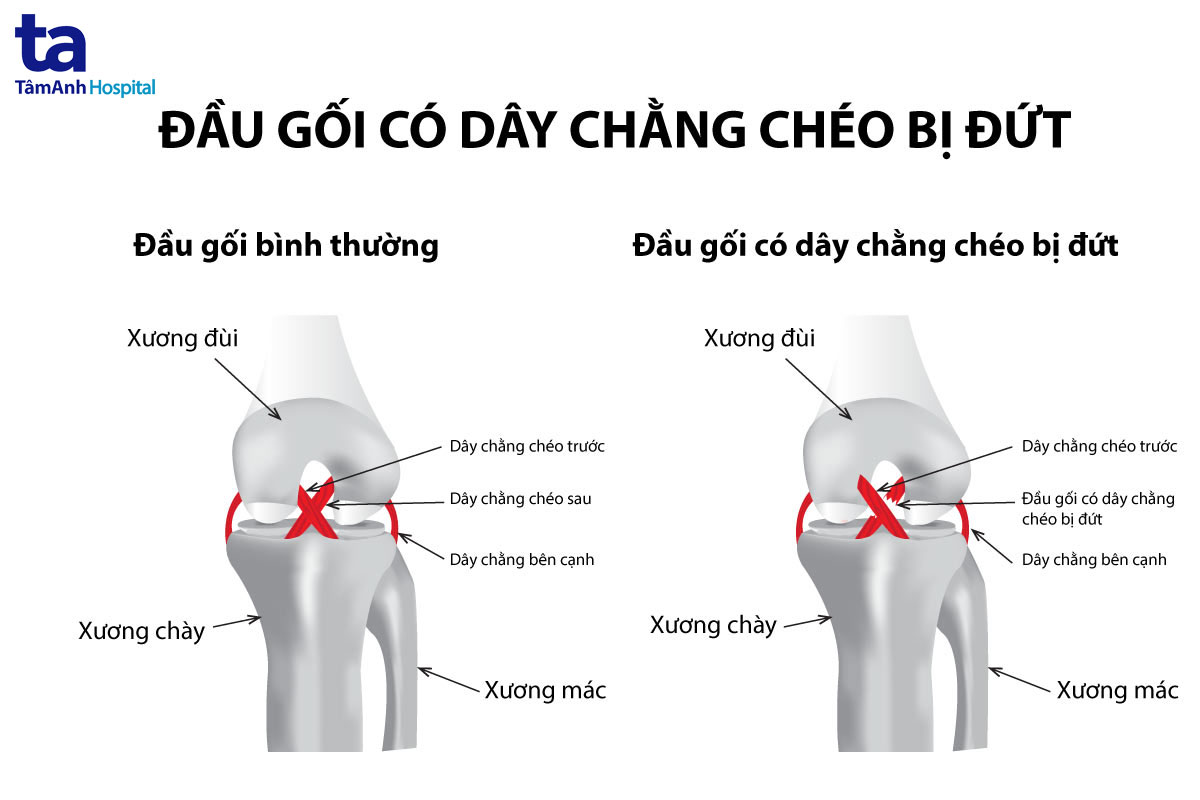 Mổ dây chằng chéo trước bao lâu bỏ nạng