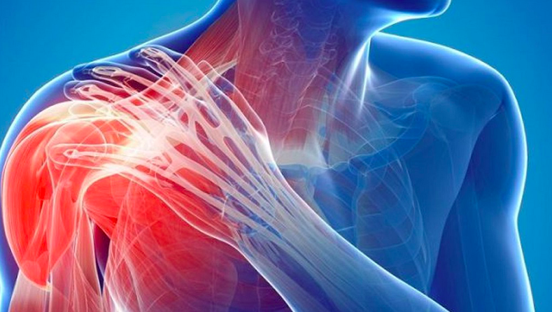 Rách cơ vai có nguy hiểm không ⚡️ BS.CKI Lê Văn Quỳnh