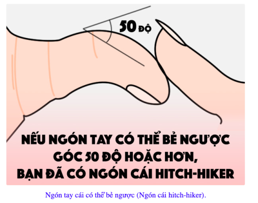 Ngón tay cái có thể bẻ ngược (Ngón cái hitch-hiker).