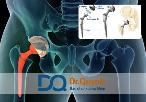 Nếu bạn cần hỗ trợ chi tiết, hãy liên hệ trực tiếp với CHUYÊN GIA, BÁC SĨ CKI LÊ VĂN QUỲNH qua website www.bslevanquynh.vn hoặc số Zalo tư vấn miễn phí 24/7: 0936231699.thay khớp háng