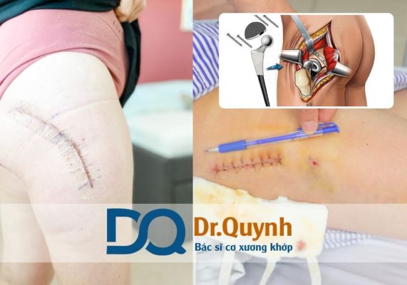 Các gói dịch vụ thay khớp háng và mức giá tương ứng Các gói dịch vụ thay khớp háng và mức giá tương ứng luôn là chủ đề được nhiều người bệnh và gia đình quan tâm khi đứng trước quyết định điều trị.