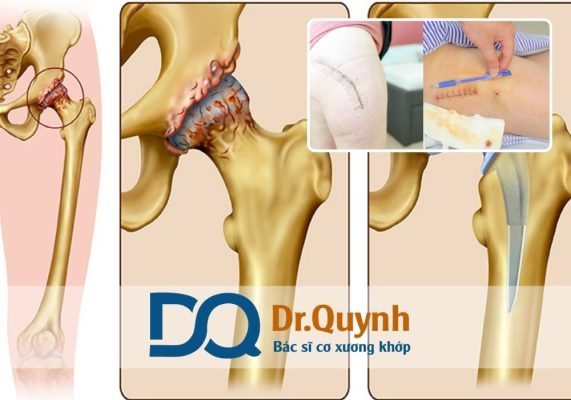 Có nên thay khớp háng ở bệnh viện tư? Trong bối cảnh nhu cầu chăm sóc sức khỏe ngày càng tăng, đặc biệt là với các ca phẫu thuật lớn như thay khớp háng, việc đưa ra quyết định đúng đắn không chỉ ảnh hưởng đến chi phí điều trị mà còn tác động lớn đến hiệu quả phục hồi lâu dài.