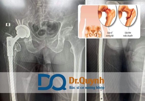 Mẹo tiết kiệm chi phí thay khớp háng tại bệnh viện tư Chi phí thay khớp háng tại các bệnh viện tư thường khiến nhiều người e ngại, đặc biệt là khi chưa có sự chuẩn bị kỹ về tài chính.