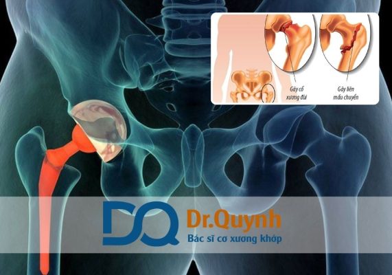 Lợi ích của việc thay khớp háng sớm và chi phí liên quan Thay khớp háng là một trong những phẫu thuật chỉnh hình phổ biến nhất hiện nay, đặc biệt ở người lớn tuổi hoặc người có bệnh lý xương khớp như thoái hóa khớp, hoại tử chỏm xương đùi, gãy cổ xương đùi không thể bảo tồn.