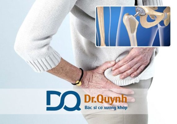 Thay khớp háng là một trong những phẫu thuật có chi phí khá cao, dao động từ 50 đến hơn 150 triệu đồng tùy vào loại khớp và nơi thực hiện.