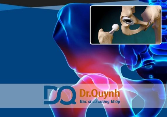 Thay khớp háng là một phương pháp điều trị hiệu quả cho các bệnh lý thoái hóa, hoại tử, viêm khớp nặng…