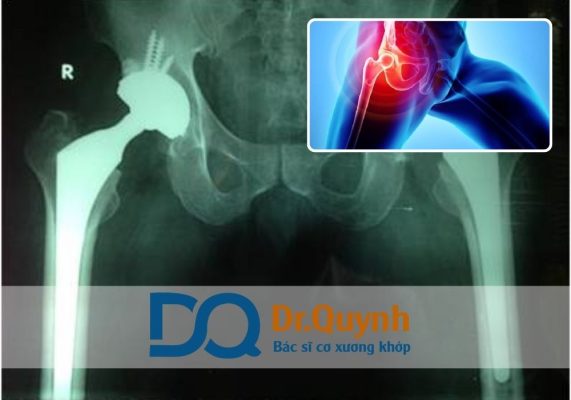Chi phí thay khớp háng ở các bệnh viện công: So với bệnh viện tư Chi phí thay khớp háng là yếu tố quan tâm hàng đầu của bệnh nhân khi quyết định điều trị căn bệnh này.