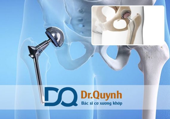 Chi phí thay khớp háng: Các khoản phí cần chuẩn bị trước khi phẫu thuật Chi phí thay khớp háng là một trong những yếu tố khiến nhiều bệnh nhân và người nhà lo lắng khi đối mặt với tình trạng thoái hóa nặng, hoại tử chỏm xương đùi, hay gãy cổ xương đùi ở người cao tuổi.