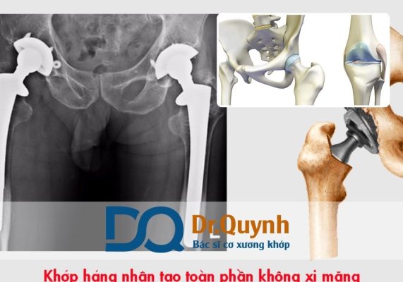 Mức độ chi phí thay khớp háng ở các bệnh viện chuyên khoa xương khớp hiện nay đang là một trong những yếu tố khiến người bệnh và người nhà cân nhắc kỹ lưỡng trước khi đưa ra quyết định điều trị.