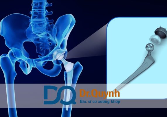 Bệnh viện nào có chi phí thay khớp háng thấp nhưng chất lượng tốt? Bệnh viện nào có chi phí thay khớp háng thấp nhưng chất lượng tốt? Đây là câu hỏi rất nhiều bệnh nhân quan tâm, đặc biệt với những người không có điều kiện tài chính dồi dào nhưng vẫn mong muốn được phẫu thuật tại nơi uy tín, an toàn và đạt hiệu quả cao.
