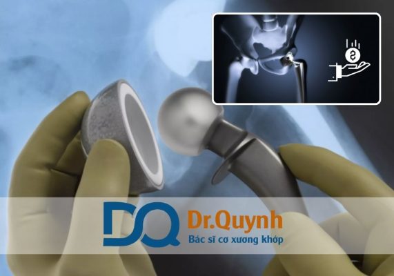 Tìm hiểu 5 lý do khiến chi phí thay khớp háng cao Chi phí thay khớp háng hiện nay được đánh giá là khá cao, khiến nhiều người bệnh băn khoăn trước quyết định phẫu thuật.