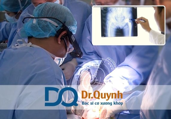 Chi phí thay khớp háng tại Hà Nội và TP.HCM Chúng ta cùng tìm hiểu về chi phí thay khớp háng – một yếu tố then chốt ảnh hưởng đến quyết định điều trị của người bệnh, đặc biệt tại các bệnh viện lớn ở Hà Nội và TP.HCM.