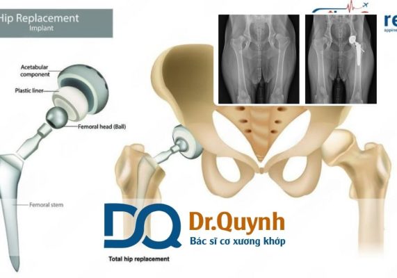 Quy trình và chi phí thay khớp háng cần biết Quy trình thay khớp háng là một trong những phẫu thuật chỉnh hình phổ biến giúp người bệnh khắc phục tình trạng đau đớn và suy giảm vận động do thoái hóa hoặc chấn thương khớp háng.