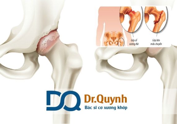 Thay khớp háng có được BHYT không? Thay khớp háng là một phẫu thuật trong đó khớp háng bị tổn thương nghiêm trọng (do thoái hóa, chấn thương, hoại tử vô khuẩn chỏm xương đùi...) được thay thế bằng khớp nhân tạo.