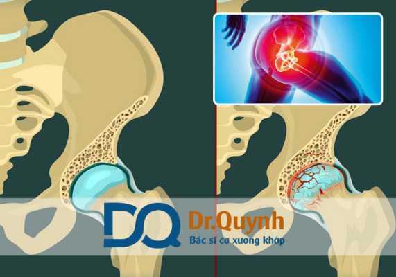 Các gói dịch vụ thay khớp háng và mức giá tương ứng Trong những năm gần đây, nhu cầu thay khớp háng ngày càng tăng cao tại Việt Nam, đặc biệt là ở người lớn tuổi và người gặp chấn thương nặng vùng háng – hông.