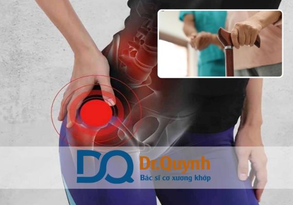 Chi phí thay khớp háng cho bệnh nhân quốc tế Chi phí thay khớp háng cho bệnh nhân nước ngoài là vấn đề được quan tâm không chỉ bởi người bệnh mà còn từ các đơn vị y tế quốc tế, đặc biệt trong xu hướng du lịch y tế phát triển mạnh mẽ tại Việt Nam.