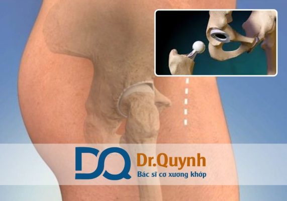 Các gói dịch vụ thay khớp háng và mức giá tương ứng Nếu bạn hoặc người thân đang có nhu cầu phẫu thuật thay khớp háng, đừng ngần ngại liên hệ CHUYÊN GIA, BÁC SĨ CKI LÊ VĂN QUỲNH để được tư vấn miễn phí, lập kế hoạch điều trị hiệu quả và phù hợp nhất.