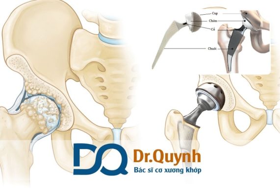 Có nên thay khớp háng ở bệnh viện tư? Bạn có thể tham khảo gói tại phòng khám của CHUYÊN GIA, BÁC SĨ CKI LÊ VĂN QUỲNH – nơi áp dụng linh hoạt các hình thức thanh toán, hỗ trợ từng trường hợp cụ thể.