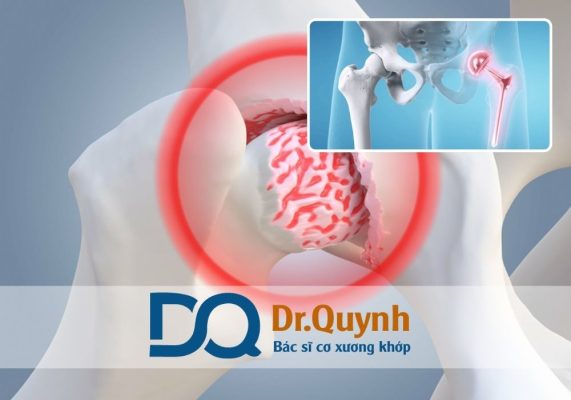 Lợi ích của việc thay khớp háng sớm và chi phí liên quan Nếu bạn hoặc người thân đang gặp vấn đề về khớp háng, hãy mạnh dạn liên hệ CHUYÊN GIA, BÁC SĨ CKI LÊ VĂN QUỲNH để được tư vấn và điều trị kịp thời!