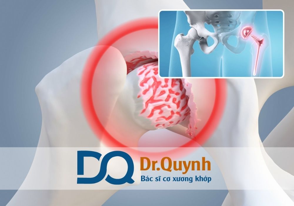 Nếu bạn hoặc người thân đang gặp vấn đề về khớp háng, hãy mạnh dạn liên hệ CHUYÊN GIA, BÁC SĨ CKI LÊ VĂN QUỲNH để được tư vấn và điều trị kịp thời!