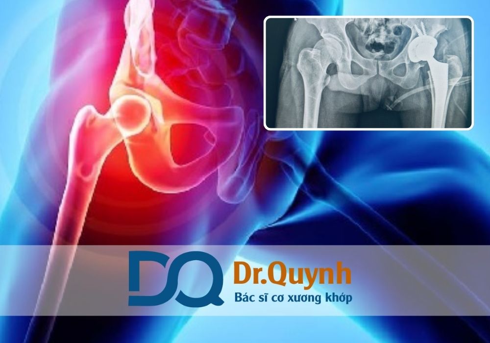 Nếu bạn vẫn đang phân vân, hãy liên hệ với CHUYÊN GIA, BÁC SĨ CKI LÊ VĂN QUỲNH – người đã thực hiện thành công hàng trăm ca thay khớp háng với tỷ lệ phục hồi cao, thời gian mổ ngắn và cam kết đồng hành cùng người bệnh trong suốt quá trình điều trị.