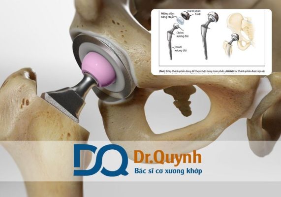 Bảo hiểm y tế không chi trả toàn bộ chi phí thay khớp háng, nhưng vẫn là chỗ dựa tài chính vững chắc cho người bệnh nếu biết cách sử dụng đúng quy định.