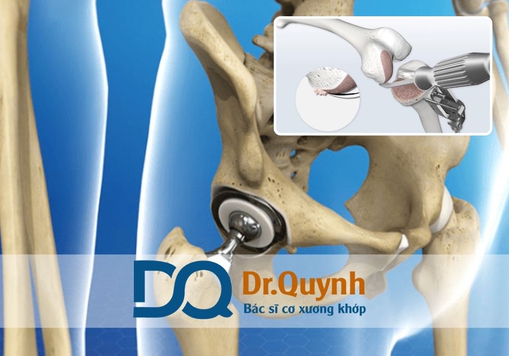 Hãy liên hệ ngay với CHUYÊN GIA, BÁC SĨ CKI LÊ VĂN QUỲNH – người đã thực hiện hàng ngàn ca thay khớp háng, luôn tận tâm tư vấn kỹ lưỡng từng khoản chi phí trước khi phẫu thuật.