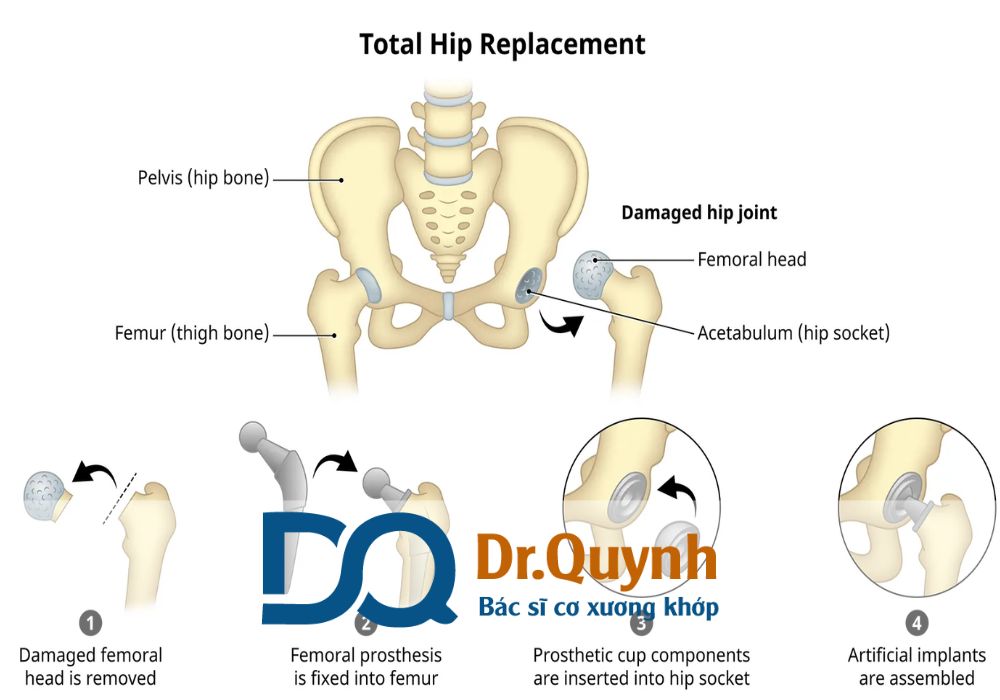 Nếu bạn muốn dịch vụ cá nhân hóa, chăm sóc hậu phẫu tốt, hỗ trợ thủ tục nhanh chóng, hãy cân nhắc lựa chọn CHUYÊN GIA, BÁC SĨ CKI LÊ VĂN QUỲNH – người luôn đặt sự an toàn, hiệu quả và tiết kiệm cho bệnh nhân lên hàng đầu.