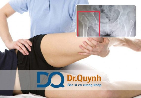 Chi phí thay khớp háng cao là điều dễ hiểu khi xét đến hàng loạt yếu tố như chất lượng khớp nhân tạo, tay nghề bác sĩ, công nghệ hỗ trợ và dịch vụ chăm sóc toàn diện.