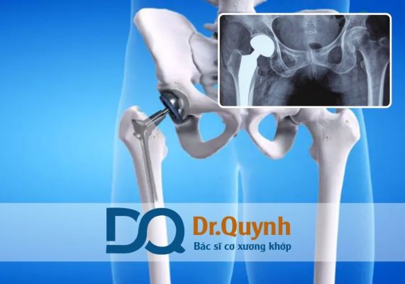 Với sự hỗ trợ từ các chuyên gia như CHUYÊN GIA, BÁC SĨ CKI LÊ VĂN QUỲNH, bạn hoàn toàn có thể an tâm thực hiện phẫu thuật thay khớp một cách an toàn, tiết kiệm và hiệu quả.