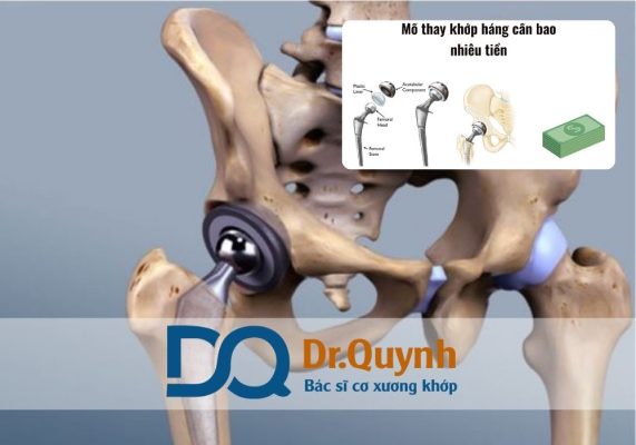 Khi nói đến phẫu thuật thay khớp háng, nhiều người lo lắng về mức chi phí thay khớp háng cũng như các dịch vụ phục hồi sau mổ.