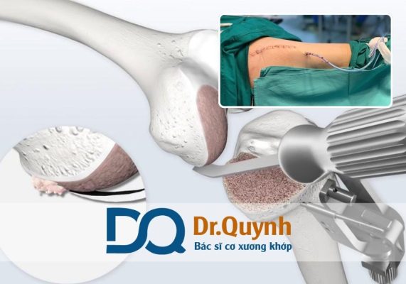 Các chương trình hỗ trợ chi phí thay khớp háng cho bệnh nhân nghèo Chi phí thay khớp háng là một trong những gánh nặng y tế lớn đối với bệnh nhân nghèo tại Việt Nam.