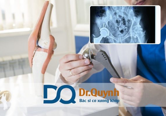 Chi phí thay khớp háng và bảo hiểm: Đảm bảo chi phí hợp lý cho người bệnh Chi phí thay khớp háng là một vấn đề lớn đối với hầu hết bệnh nhân mắc các bệnh lý về khớp háng, đặc biệt là người cao tuổi và những người lao động có thu nhập thấp.
