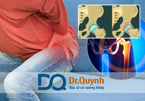 Có nên thay khớp háng ở bệnh viện tư? Trong vòng 10 năm trở lại đây, phẫu thuật thay khớp háng đã trở thành một trong những phương pháp điều trị phổ biến và hiệu quả cho người bệnh bị thoái hóa khớp, hoại tử chỏm xương đùi hay chấn thương nghiêm trọng vùng hông – háng.