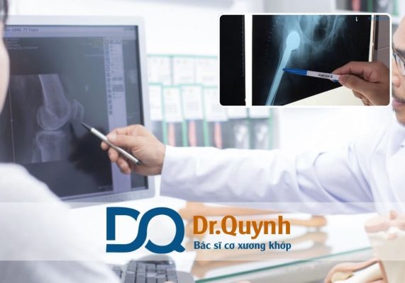 Thay khớp háng không chỉ cải thiện chức năng vận động và chất lượng sống, mà còn là một giải pháp tiết kiệm chi phí điều trị lâu dài vô cùng hiệu quả.