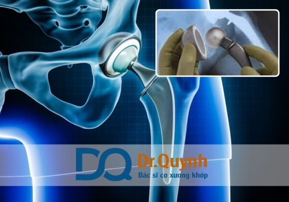 Các chương trình hỗ trợ chi phí thay khớp háng cho bệnh nhân nghèo Các chương trình hỗ trợ chi phí thay khớp háng cho bệnh nhân nghèo là cứu cánh quan trọng cho hàng ngàn người không có khả năng tài chính.