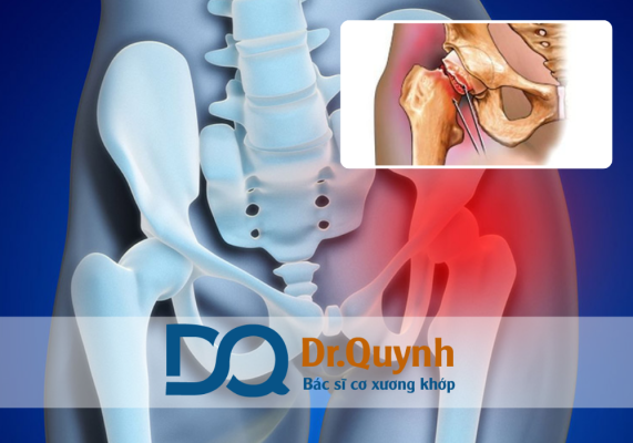 Có nên thay khớp háng ở bệnh viện tư? Tốt nhất, bạn nên tham khảo ý kiến từ chuyên gia, ví dụ như CHUYÊN GIA, BÁC SĨ CKI LÊ VĂN QUỲNH, để được tư vấn lộ trình điều trị phù hợp nhất với điều kiện sức khỏe và tài chính cá nhân.