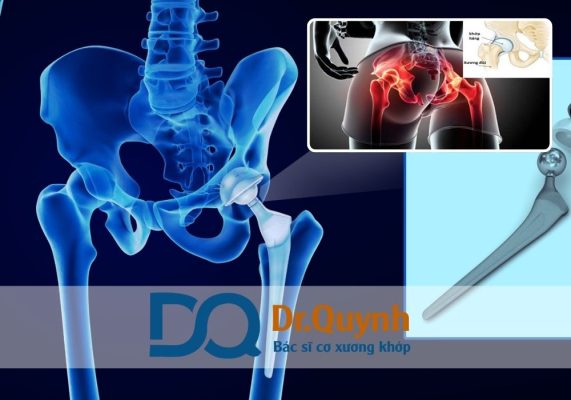 Khi tìm hiểu về chi phí thay khớp háng, rất nhiều người bệnh và người nhà gặp khó khăn trong việc lựa chọn loại khớp háng nhân tạo phù hợp.