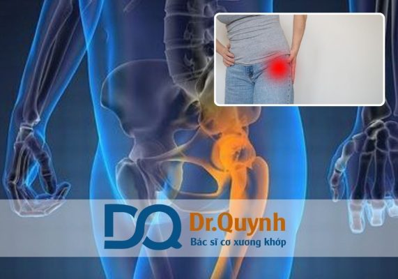 Hiểu rõ các loại khớp háng nhân tạo và sự khác biệt về chi phí thay khớp háng là bước quan trọng để bạn lựa chọn đúng đắn, phù hợp với sức khỏe và ngân sách. Đừng chỉ nhìn vào giá – hãy đầu tư vào chất lượng sống sau mổ.