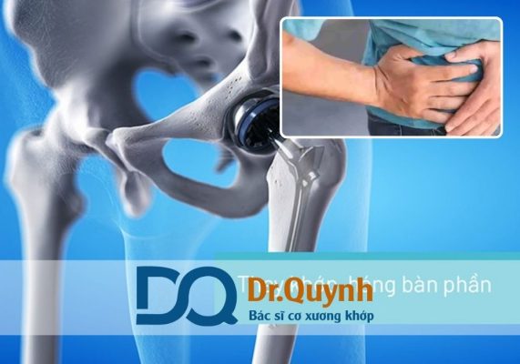 Chi phí thay khớp háng bị ảnh hưởng bởi nhiều yếu tố từ bệnh lý nền, loại khớp, bác sĩ mổ đến chế độ chăm sóc sau mổ.
