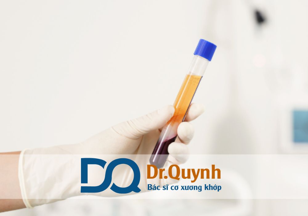 Tiêm huyết tương giàu tiểu cầu (PRP) hiện nay được xem là phương pháp điều trị tiên tiến trong phục hồi xương khớp, gân – dây chằng và cả trong lĩnh vực da liễu thẩm mỹ.